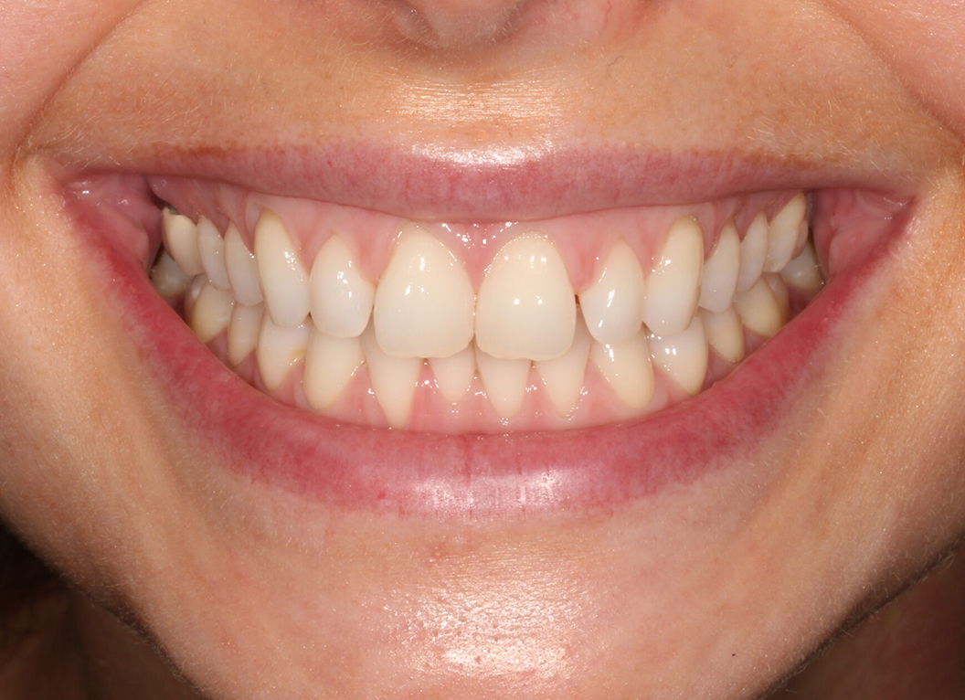 Before - The White House Dental