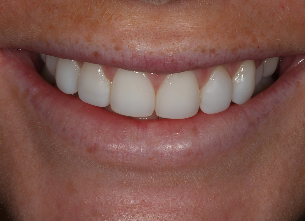 After - The White House Dental