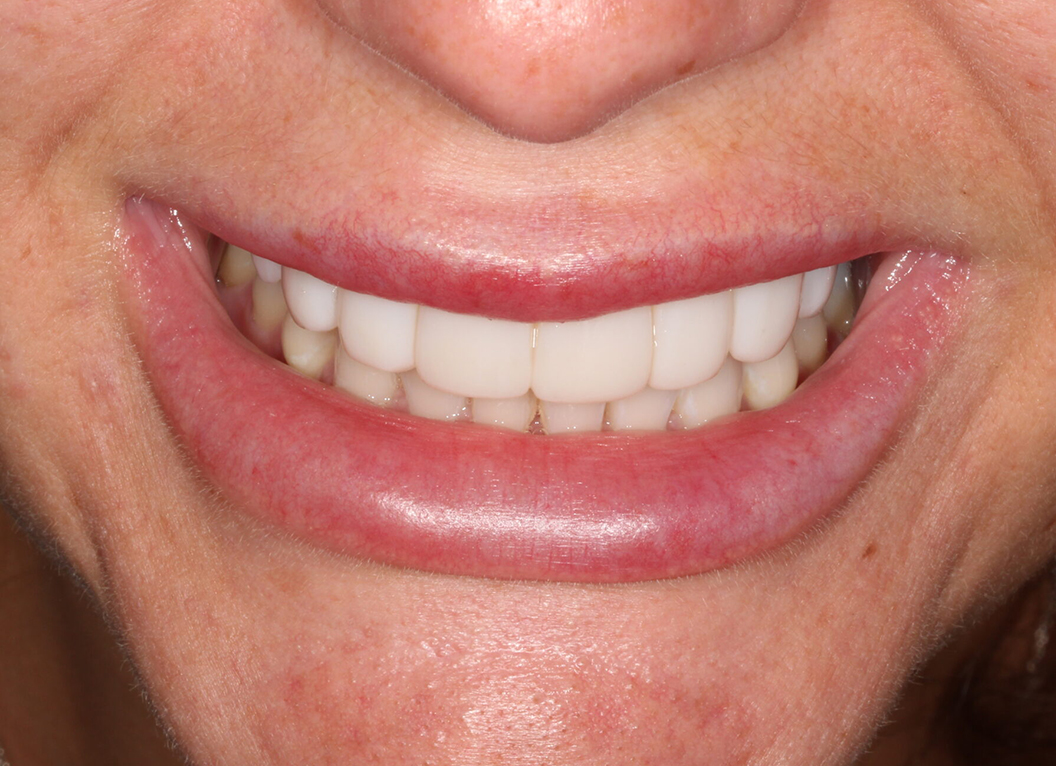 After - The White House Dental