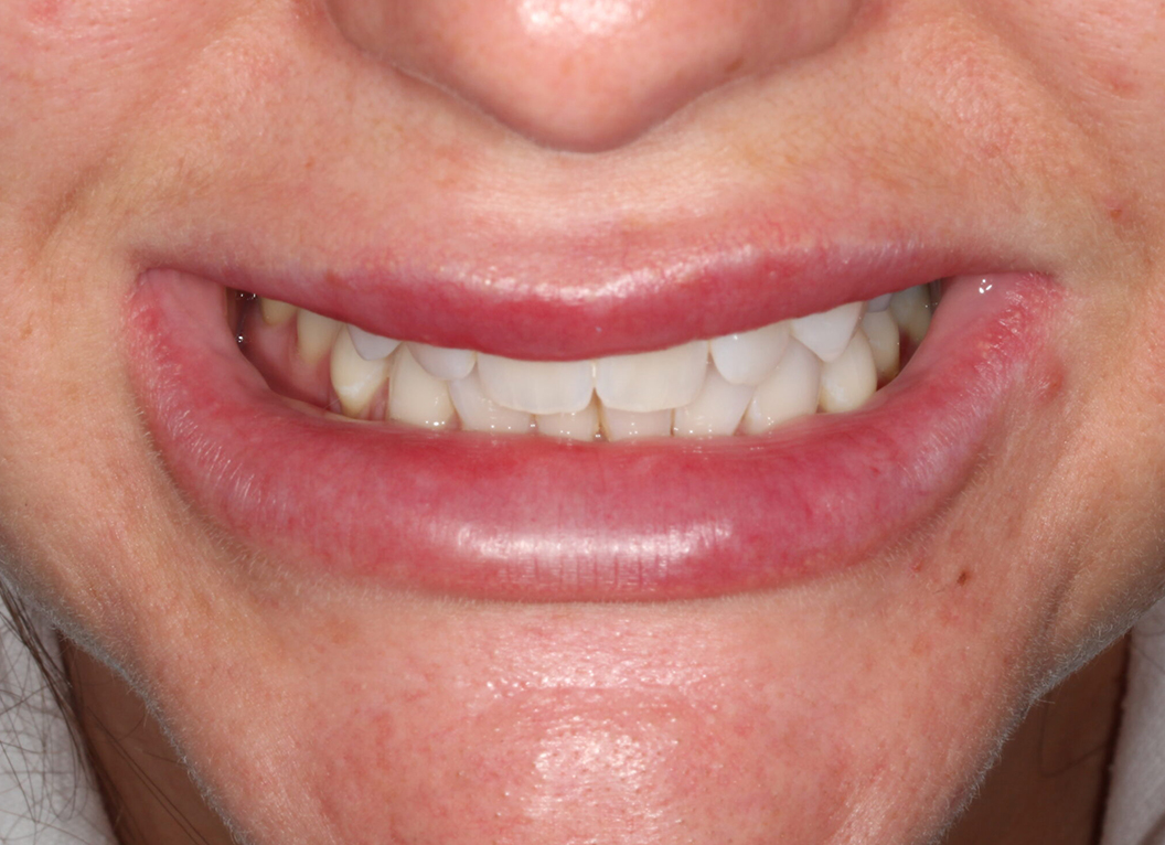 Before - The White House Dental