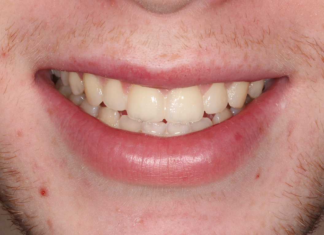 After - The White House Dental