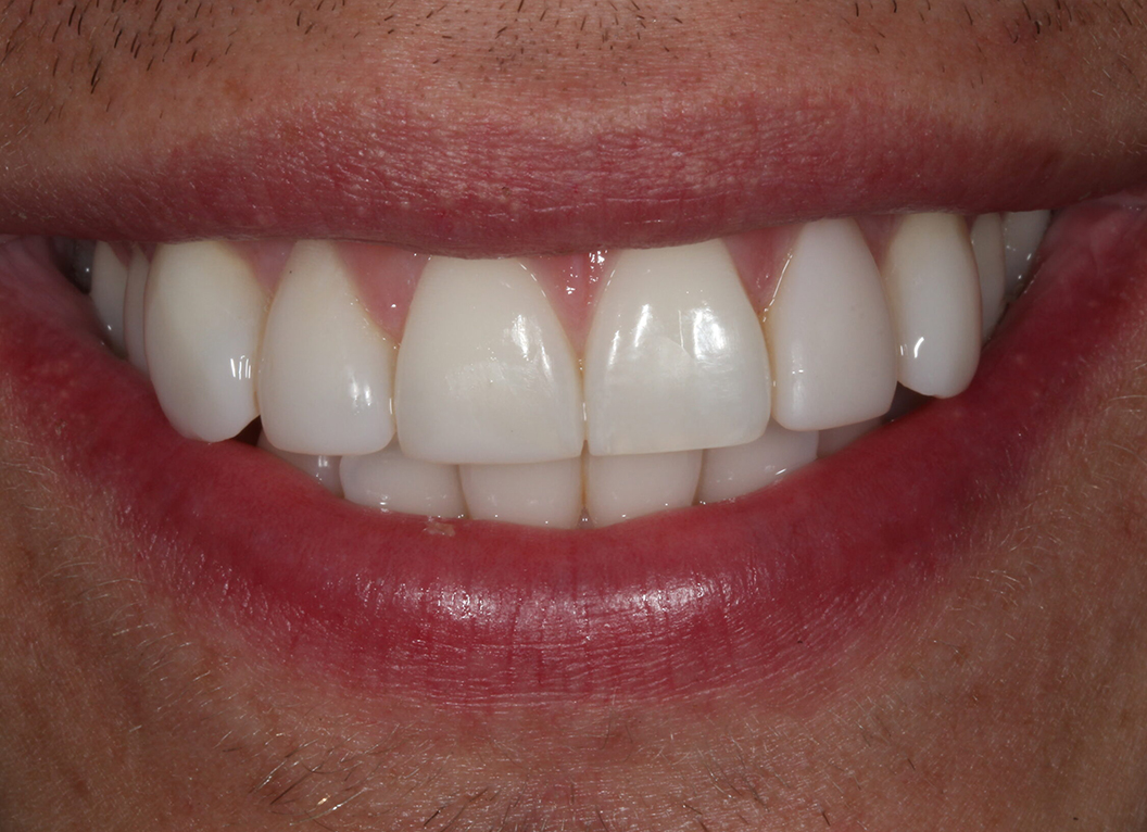 After - The White House Dental