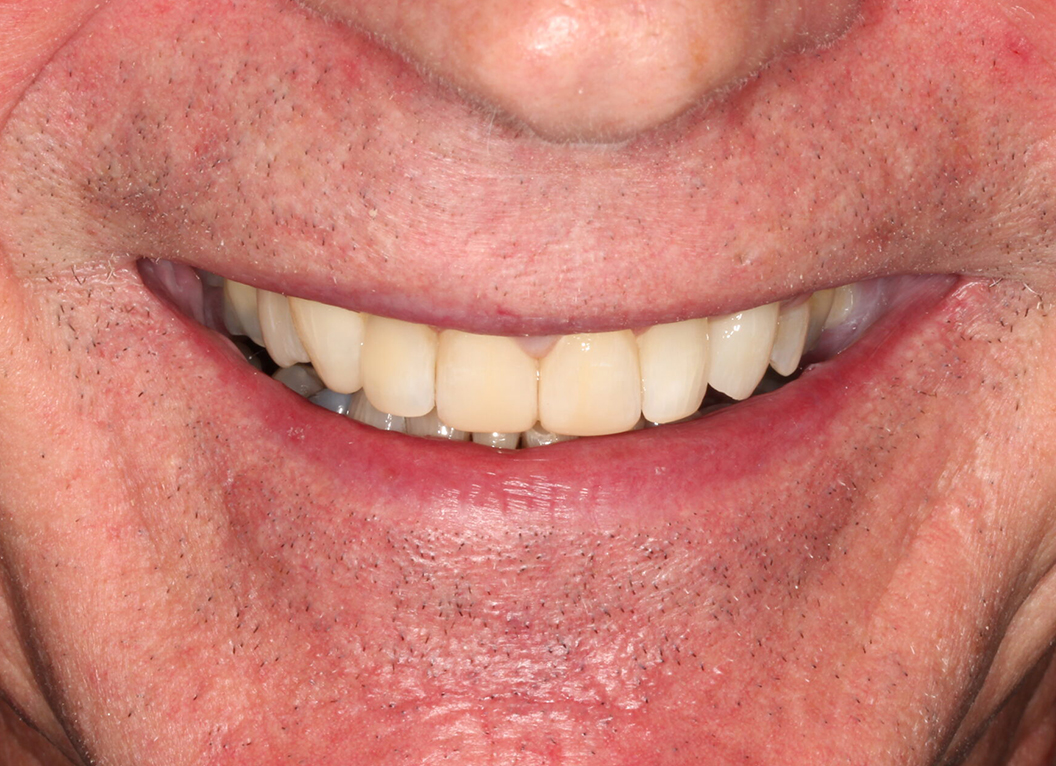 After - The White House Dental