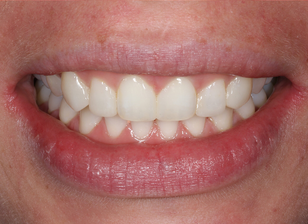 After - The White House Dental