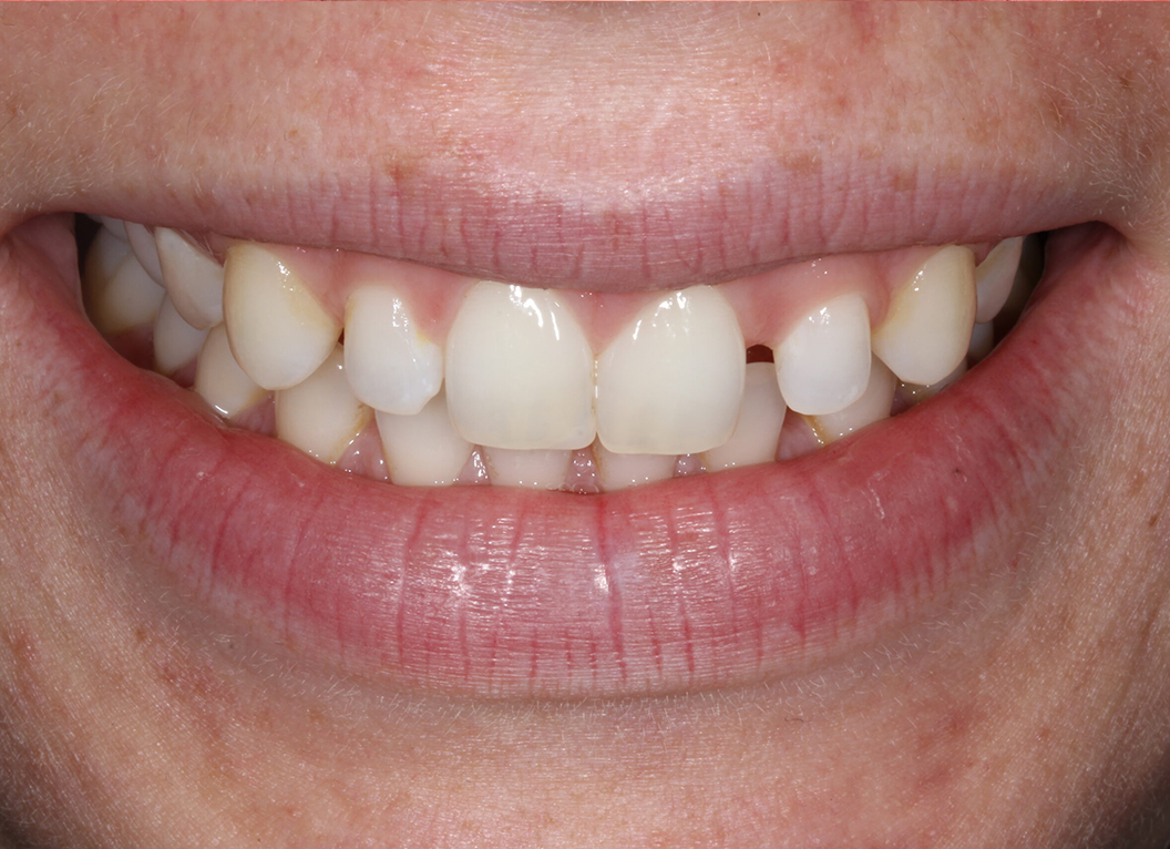 Before - The White House Dental