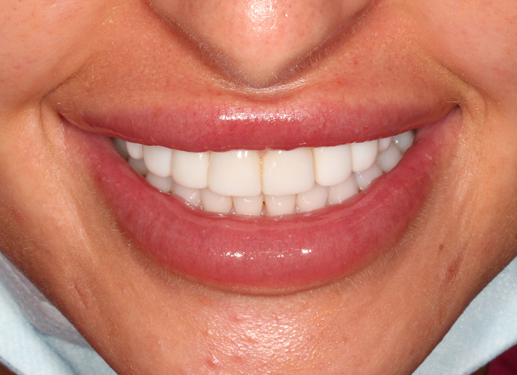 After - The White House Dental