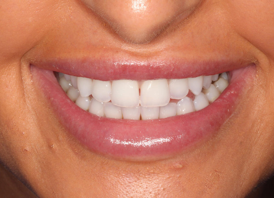 Before - The White House Dental