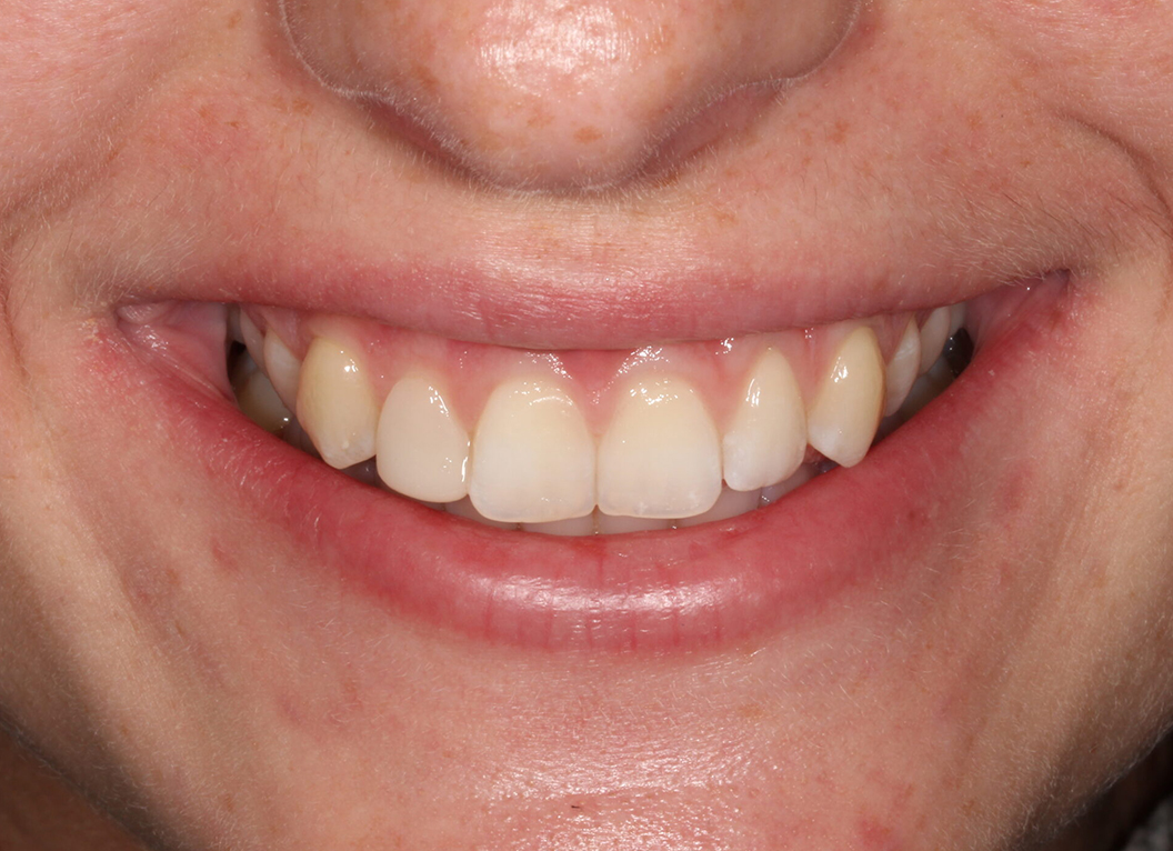 After - The White House Dental