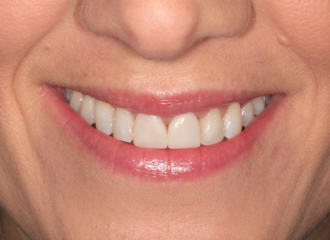 After - The White House Dental