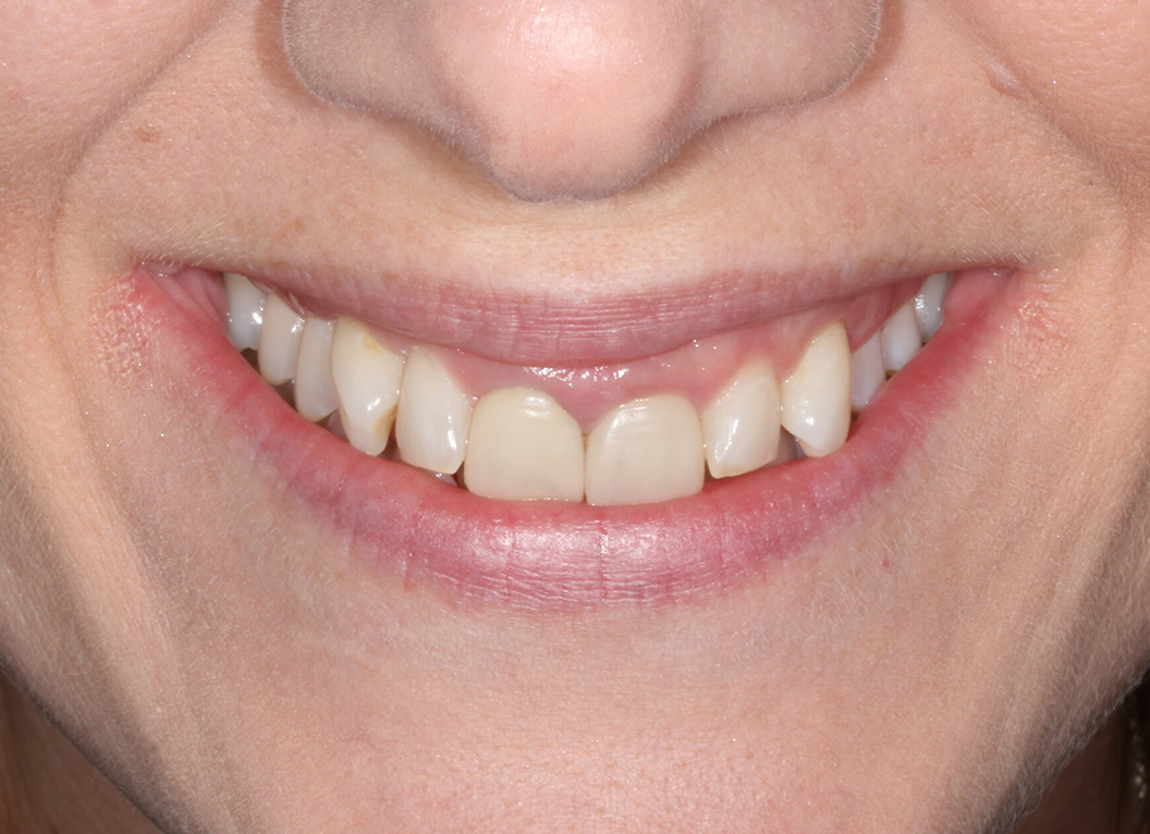 Before - The White House Dental