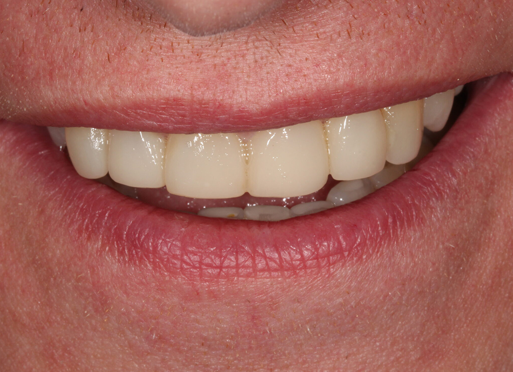 After - The White House Dental