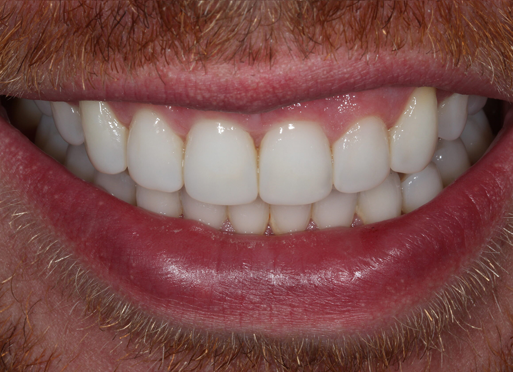 After - The White House Dental