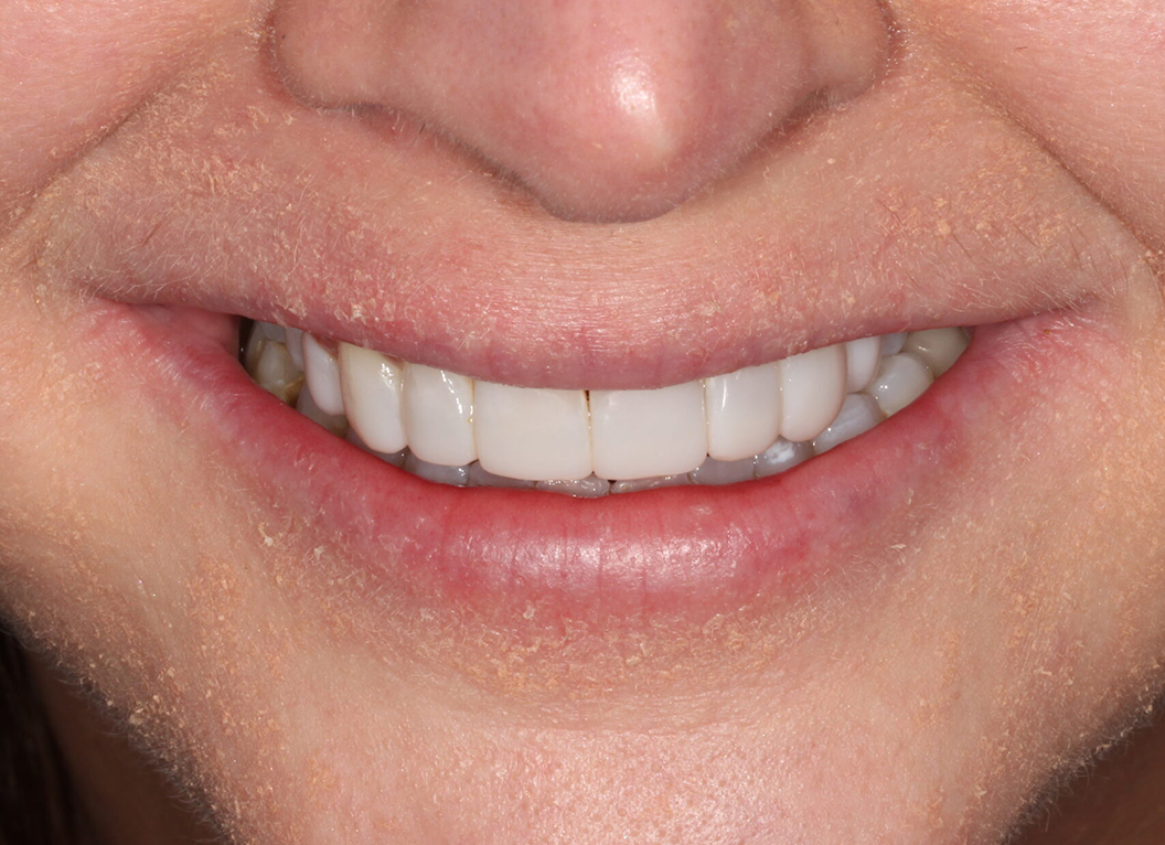 After - The White House Dental