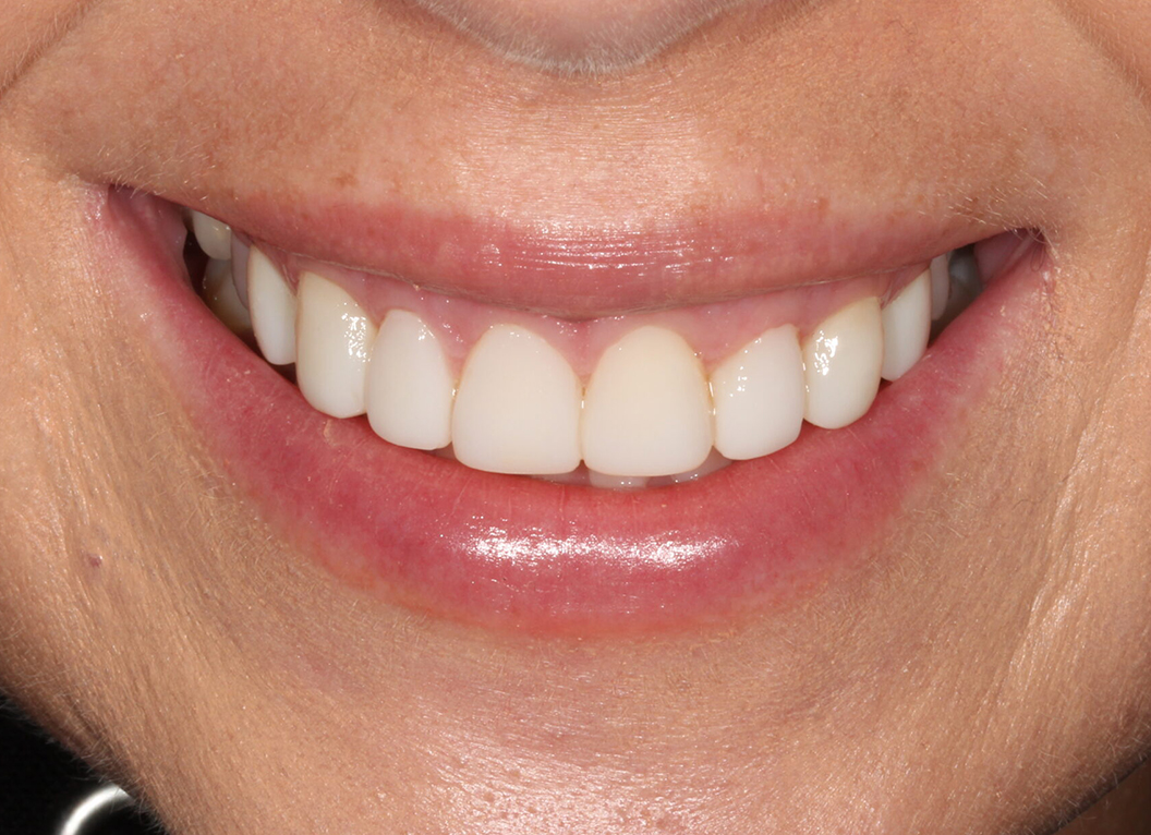 After - The White House Dental