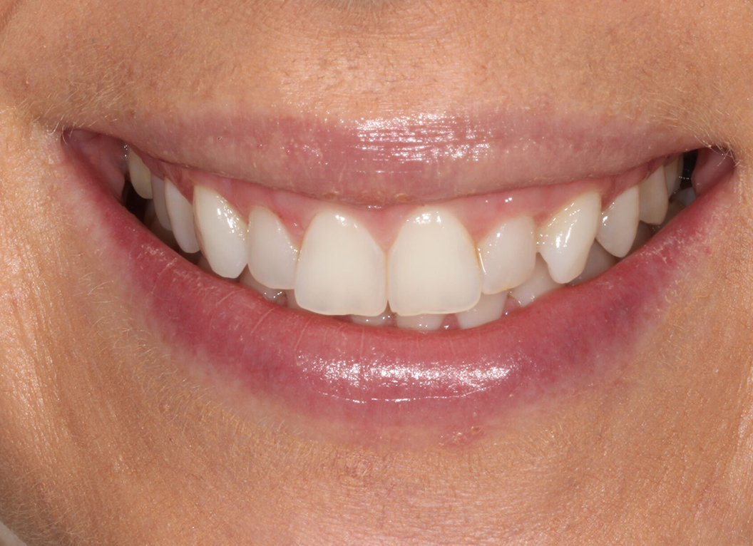 Before - The White House Dental