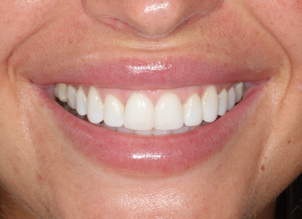 After - The White House Dental