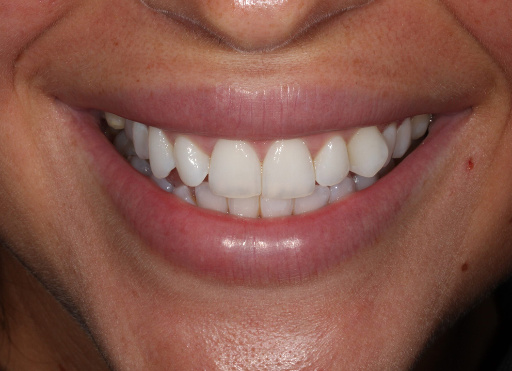 Before - The White House Dental