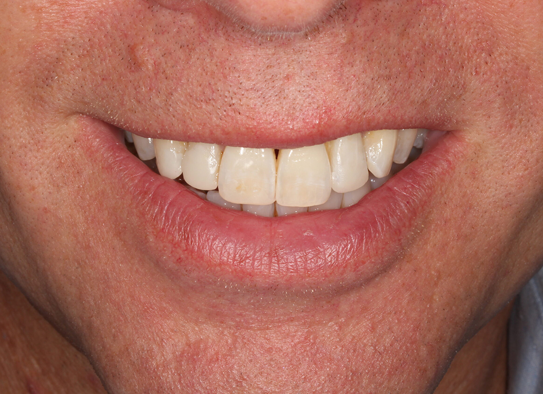 After - The White House Dental