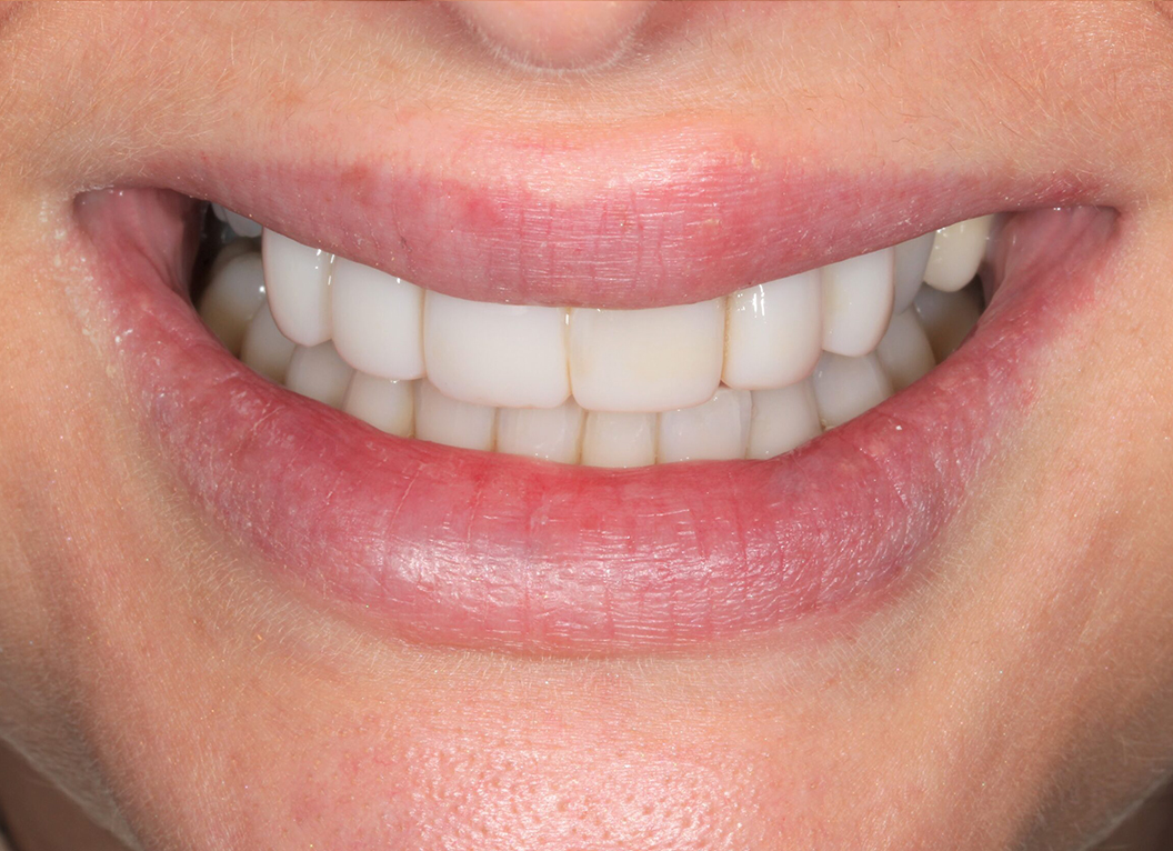 After - The White House Dental