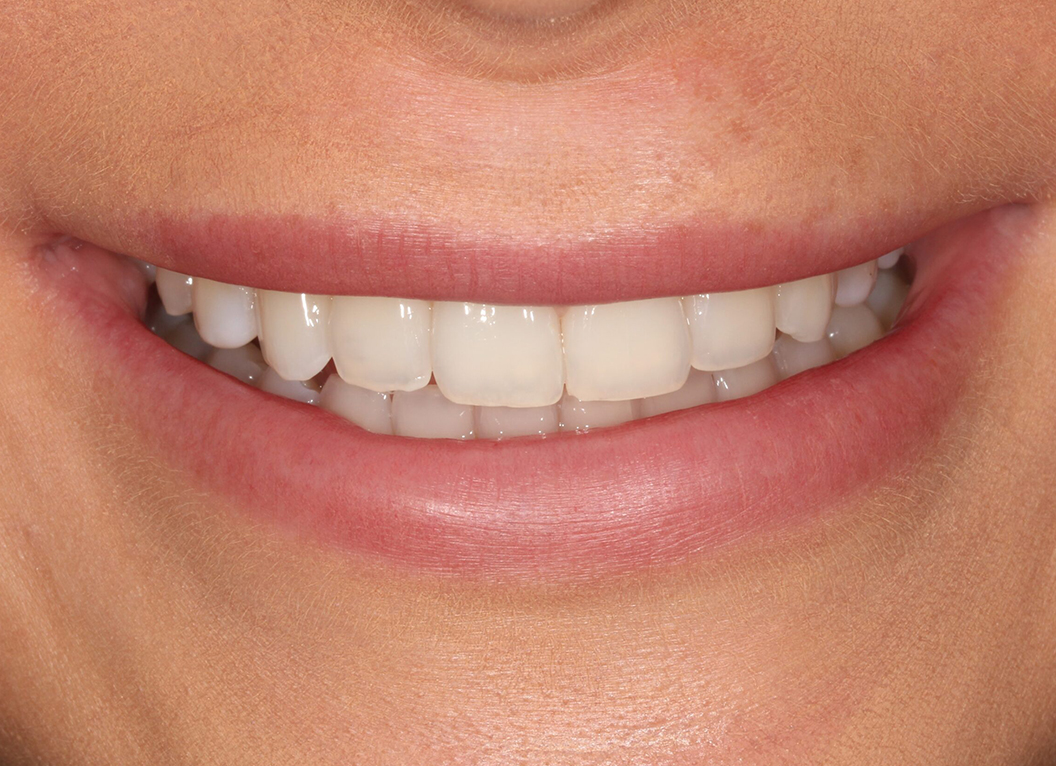 After - The White House Dental