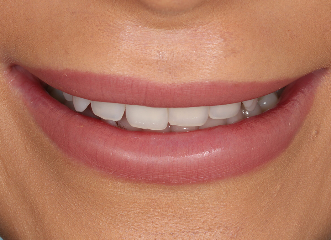 Before - The White House Dental