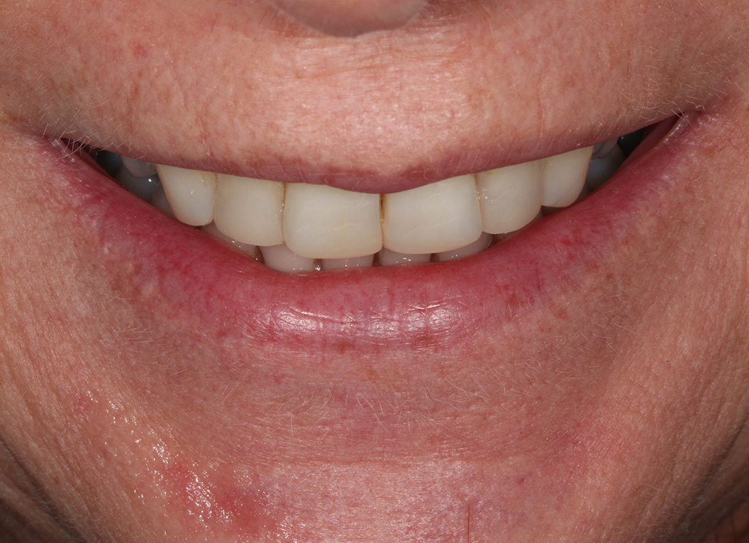 After - The White House Dental