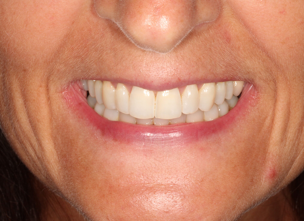 After - The White House Dental