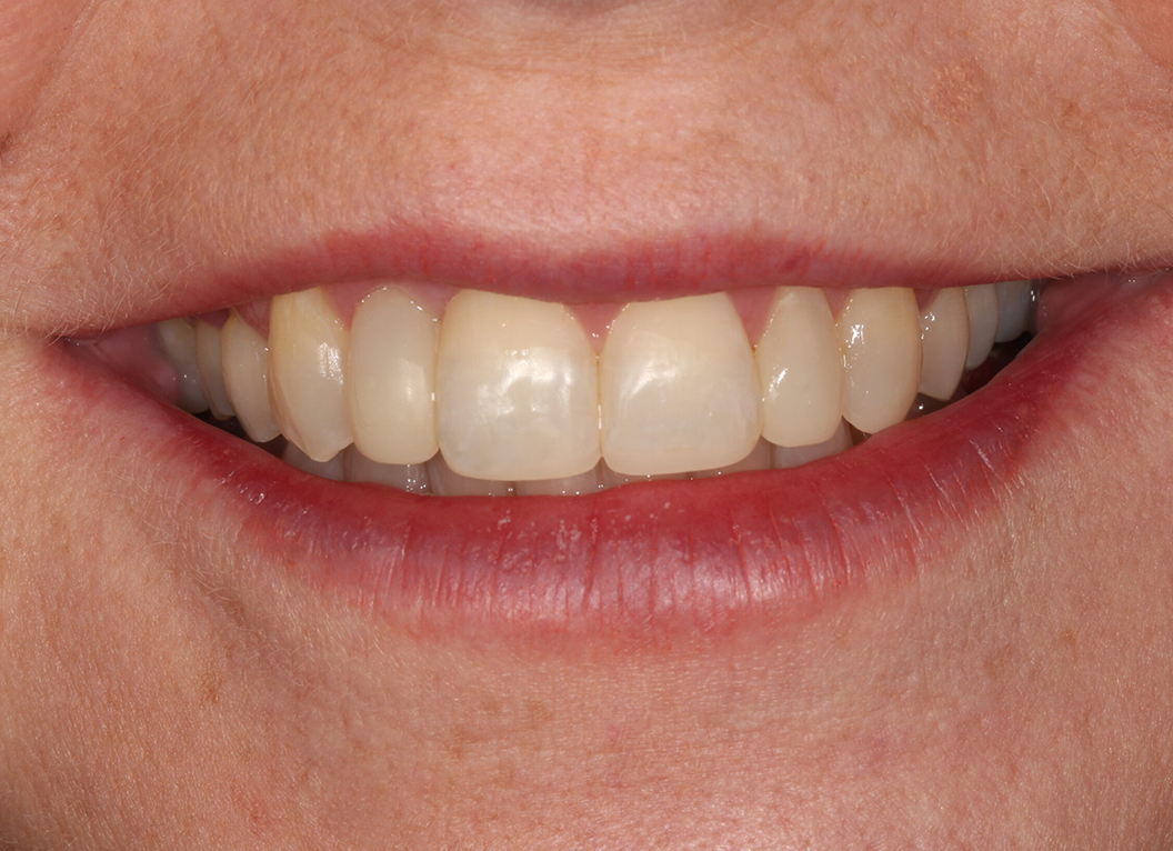 After - The White House Dental