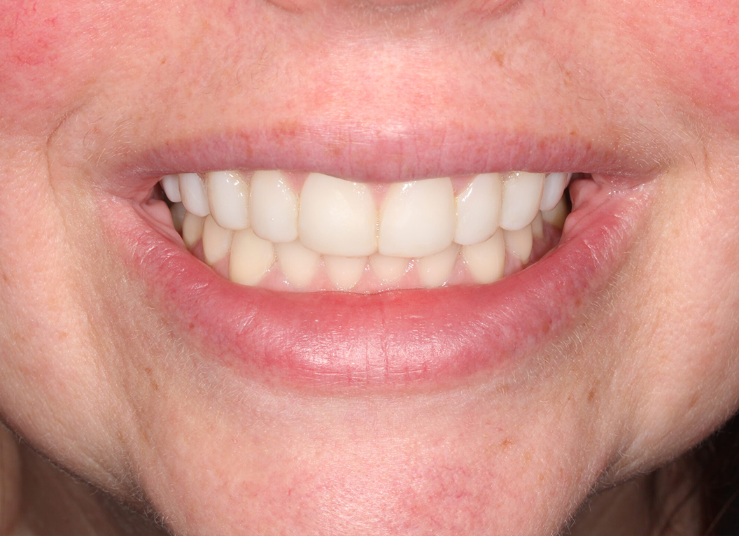 After - The White House Dental